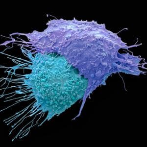 Tumore dell’ovaio resistente al platino: dati incoraggianti dall’immunoterapia