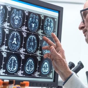 Sclerosi multipla, con i registri di malattia migliora la cura
