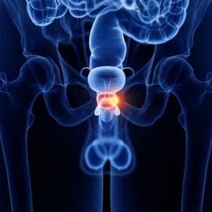 Tumore alla prostata, ancora troppi pochi diritti e tutele dopo la chirurgia