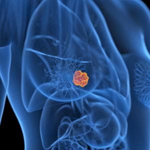 Tumore al seno, un nuovo farmaco riduce il rischio che la malattia ritorni