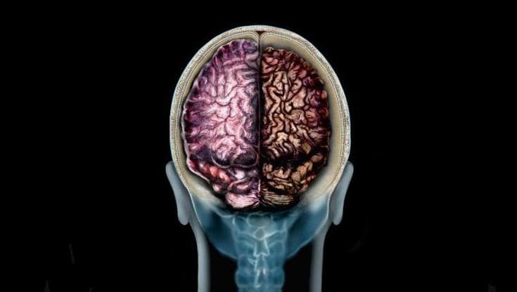 Alzheimer, scoperto il meccanismo che fa fare retromarcia alla malattia
