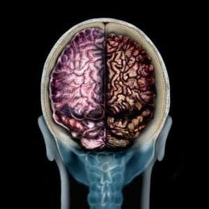 Alzheimer, scoperto il meccanismo che fa fare retromarcia alla malattia