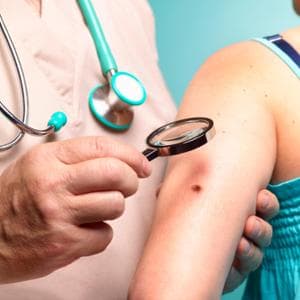 Melanomun önlenmesi için ulusal bir gün