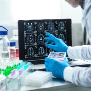 Alzheimer, incoraggianti i test su un farmaco contro l’epilessia: potrebbe prevenire la malattia