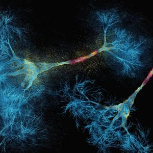Sma, la malattia inizia prima della nascita