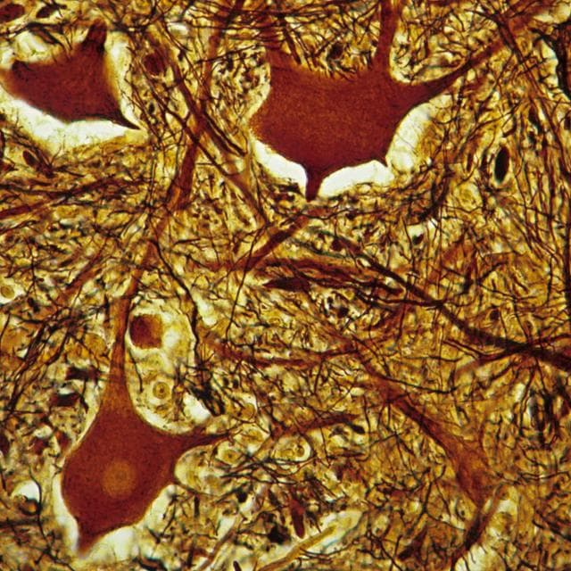 Sclerosi multipla: così muoiono i neuroni nella corteccia cerebrale
