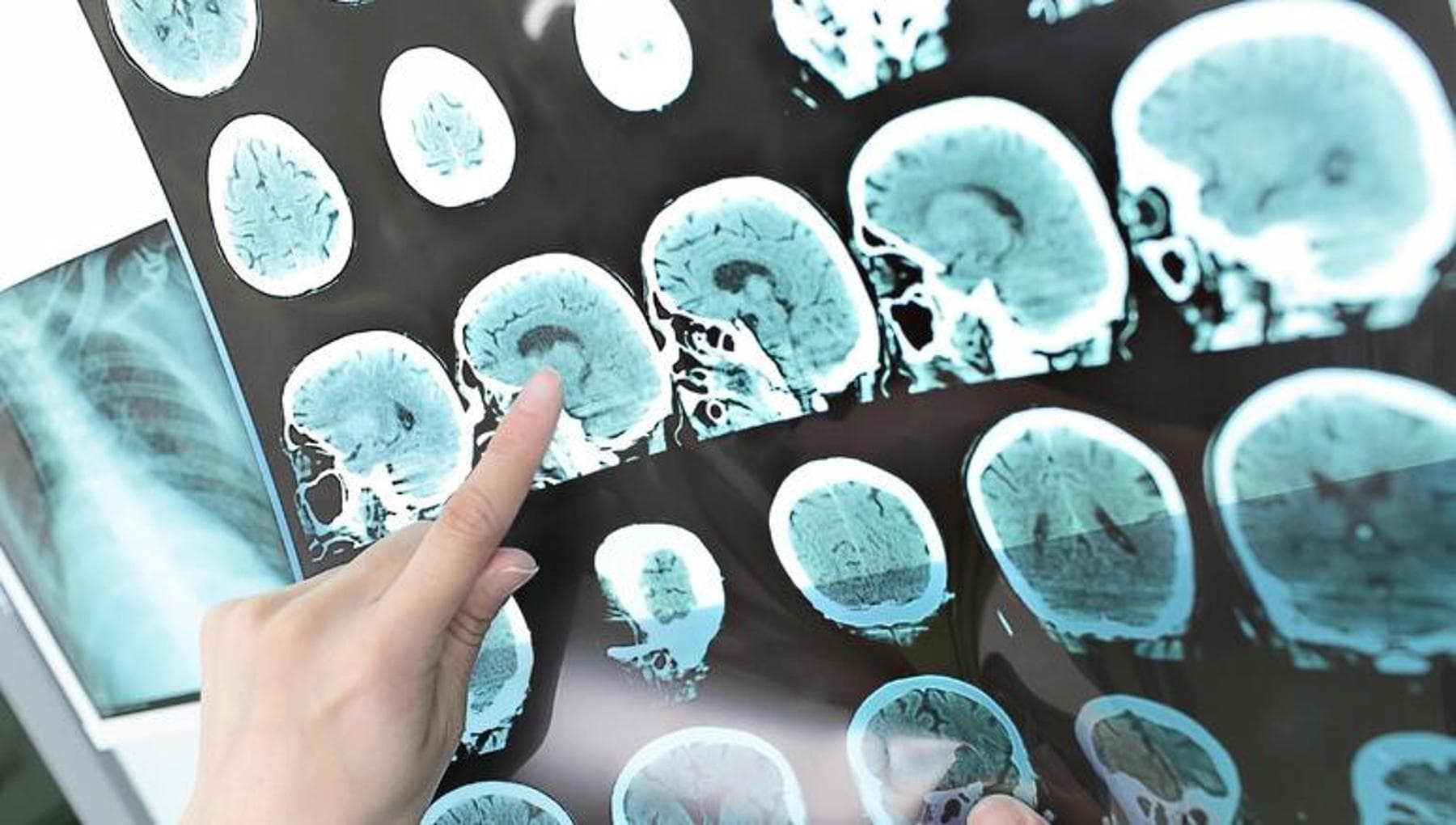 Il 75% dei pazienti sopravvive a ictus con esiti invalidanti