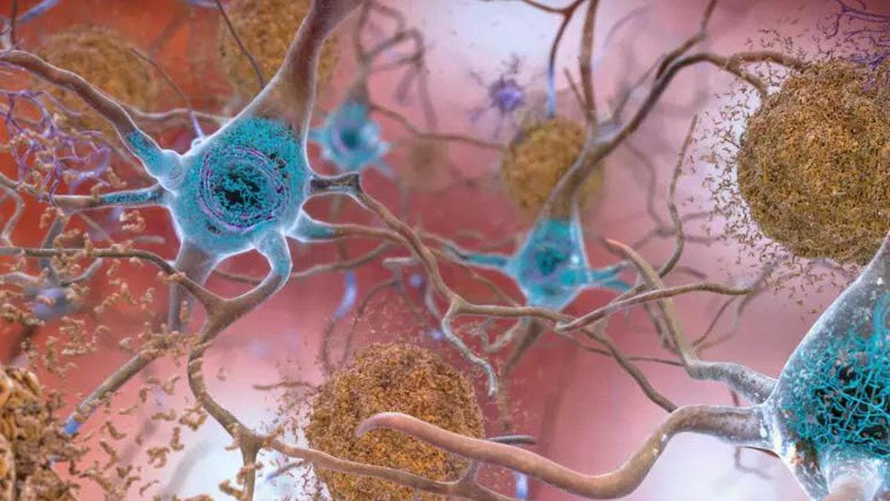 Alzheimer, i nuovi farmaci  non fermano la malattia