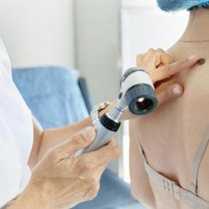 Melanoma, non conta solo il sole: fino a 2.600 casi l’anno in Italia possono essere ereditari