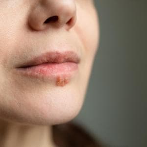 Herpes simplex'e karşı etkili ve güvenli bir aşı geliştirmek neden zordur?