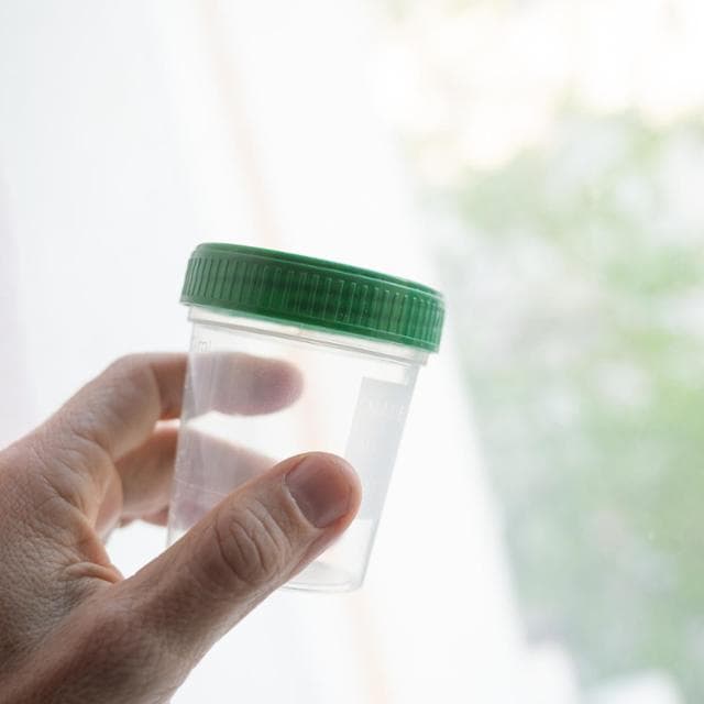 Tumore alla prostata, meno biopsie di controllo con un nuovo test sulle urine