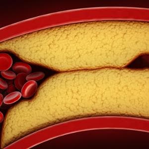 Infarto e ictus, così il colesterolo cattivo che va su e giù aumenta il rischio