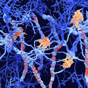 Sclerosi multipla: una diagnosi ogni tre ore. Una nuova strategia per aiutare i pazienti
