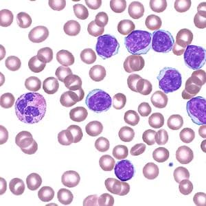 Leucemia linfatica cronica, benefici duraturi nei pazienti più grandi