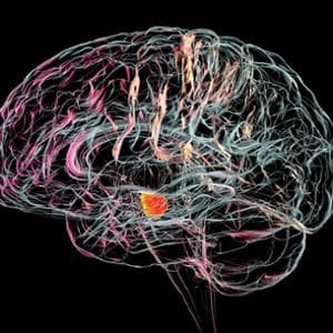 Micro-antenne nel cervello contro Parkinson ed epilessia