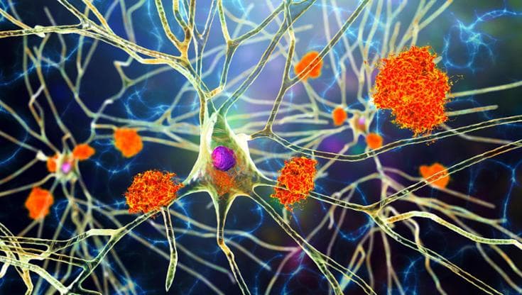 Le alterazioni della microglia possono contribuire allo sviluppo delle malattie neurodegenerative