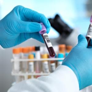 Un test del sangue potrebbe prevedere l’Alzheimer con dieci anni di anticipo