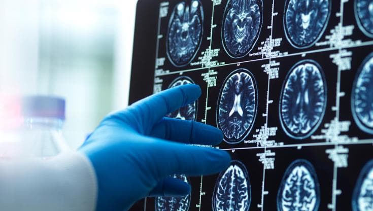 Alzheimer, scoperto il meccanismo che regola la perdita delle sinapsi