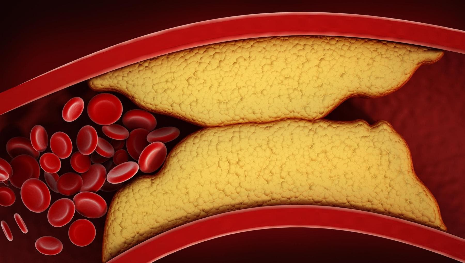 Photo: repubblica.it LDL Cholesterol: Who Needs Oral Medications and When to Use Them