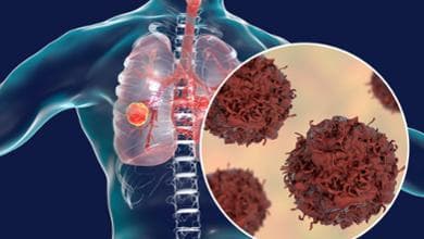 Tumore al polmone con mutazione HER2: nuova possibile opzione terapeutica in prima linea