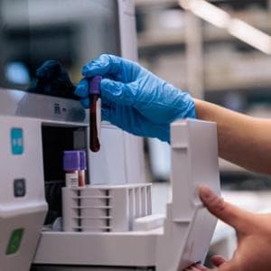 Tumore al pancreas: un nuovo test del sangue aiuterà a trovarlo prima