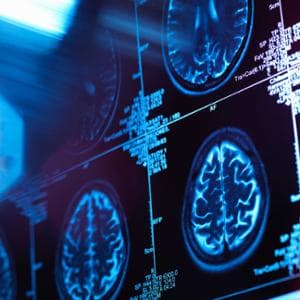 Previsioni, sintomi e nuove cure: le cinque risposte sull’Alzheimer