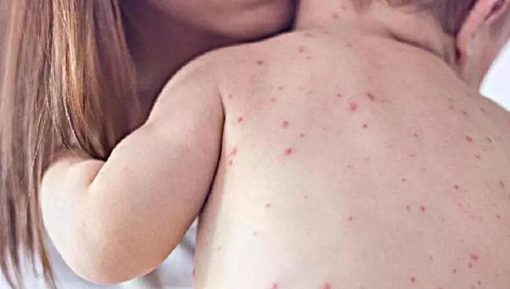 Morbillo, contagi in crescita del 78%: una persona può infettarne 17