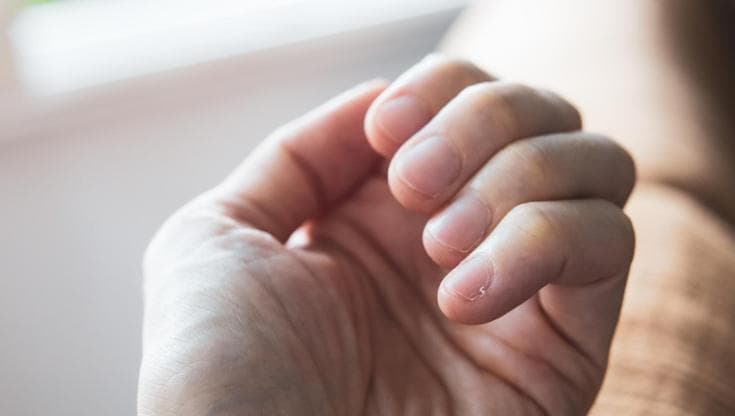 I nuovi farmaci anti-obesità aumentano il rischio di problemi alle unghie