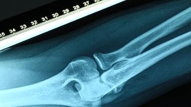 Malattie rare delle ossa, fino a 15 anni per una diagnosi: “Necessario abbattere tempi di attesa”