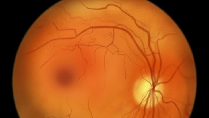 Retinite pigmentosa, scoperto un nuovo gene responsabile della malattia