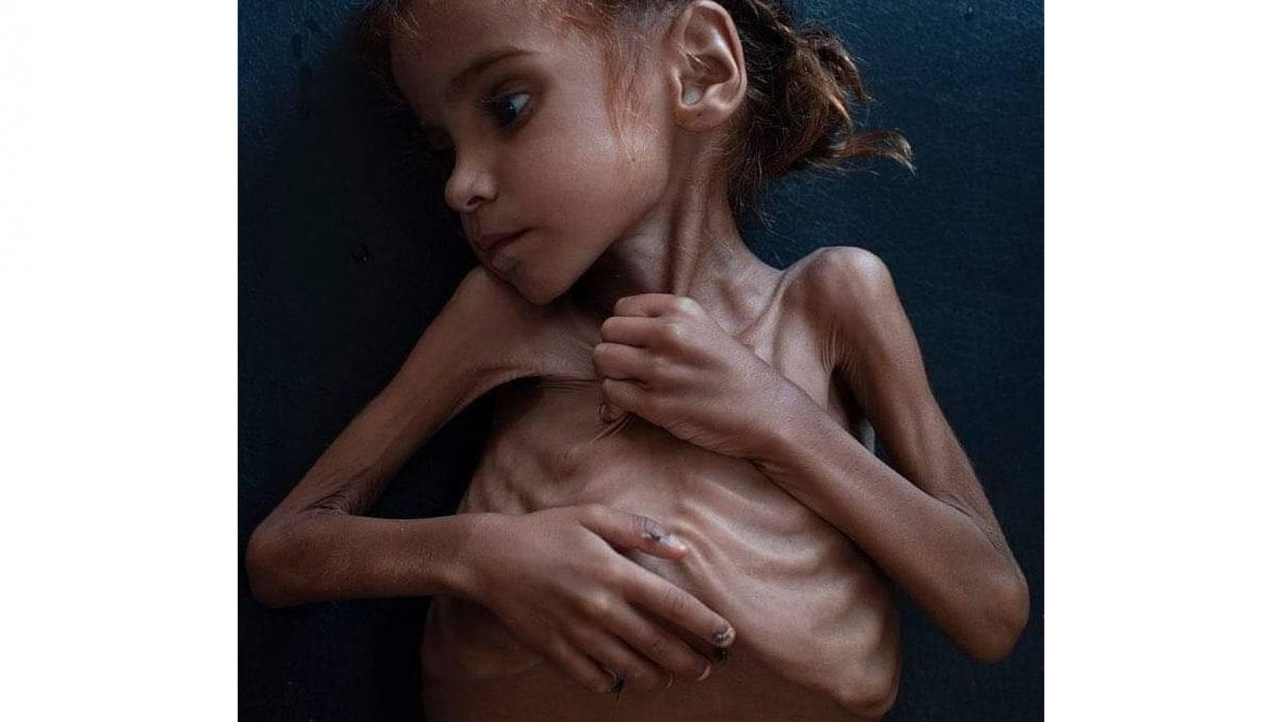 Il 26 ottobre 2018 il "New York Times" pubblic&ograve; la foto di Amal, 7 anni.&nbsp;La bambina mor&igrave; pochi giorni dopo