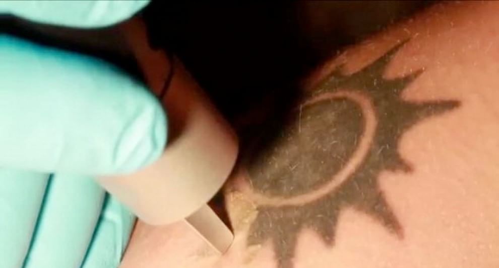 Tatuaggi, il decalogo per rimuoverli