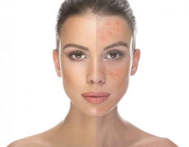 Come combattere l'acne