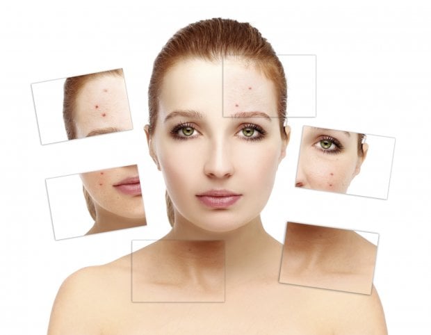 Come combattere l'acne
