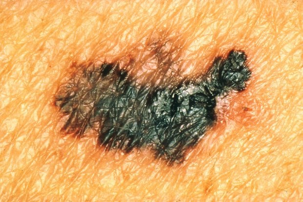 Melanoma: campanelli d'allarme e comportamenti da evitare 