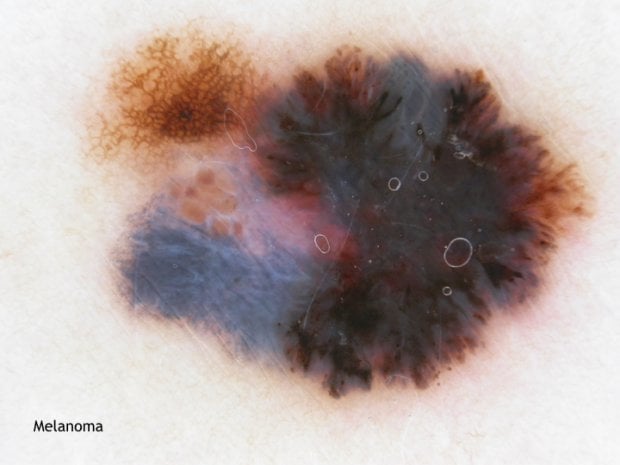 Melanoma: campanelli d'allarme e comportamenti da evitare 