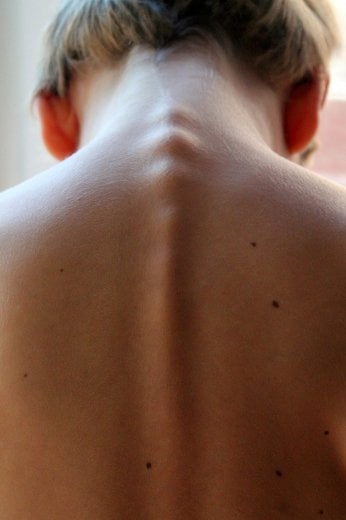 Melanoma: campanelli d'allarme e comportamenti da evitare 