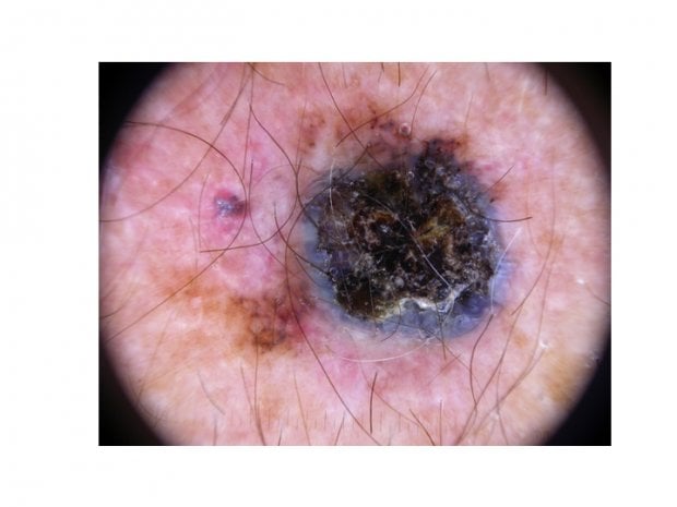 Melanoma: campanelli d'allarme e comportamenti da evitare 