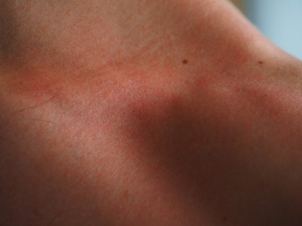 Melanoma: campanelli d'allarme e comportamenti da evitare 