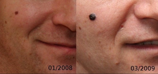Melanoma: campanelli d'allarme e comportamenti da evitare 