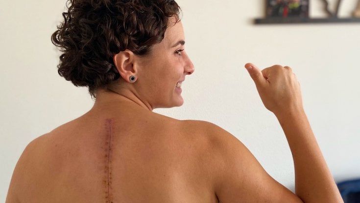 Ana Carrasco mostra la cicatrice dell'intervento alla schiena