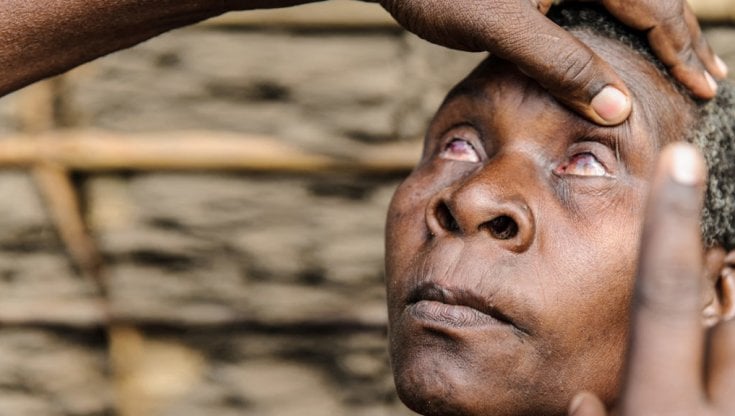 Almeno 2,2 miliardi di persone sono afflitte da gravi disturbi oculari o cecità: antiche malattie della povertà, la storia di Mulu 