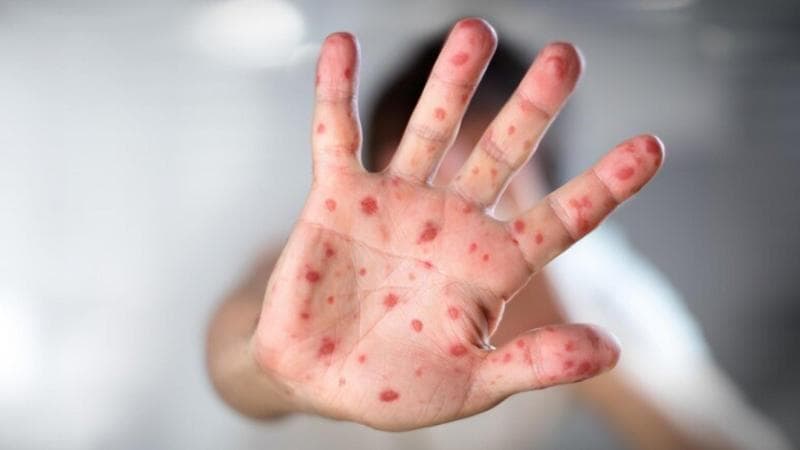 Il morbillo rialza la testa in Italia. Quest’anno 213 casi, il quintuplo dell’intero 2023. In calo le vaccinazioni