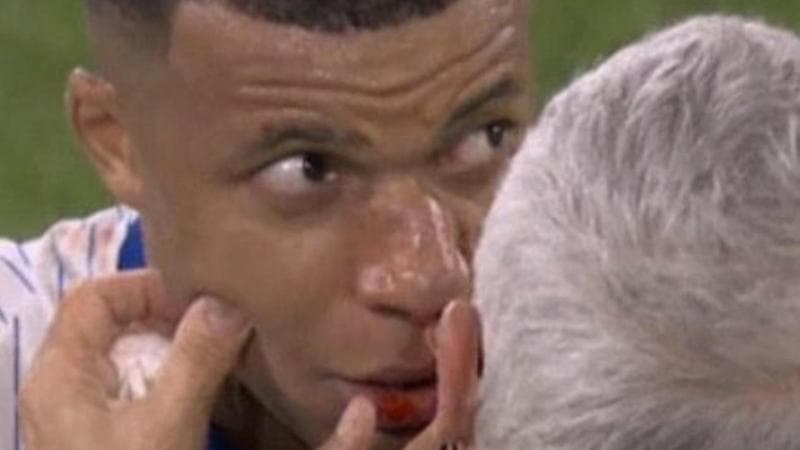 Mbappé col naso rotto
