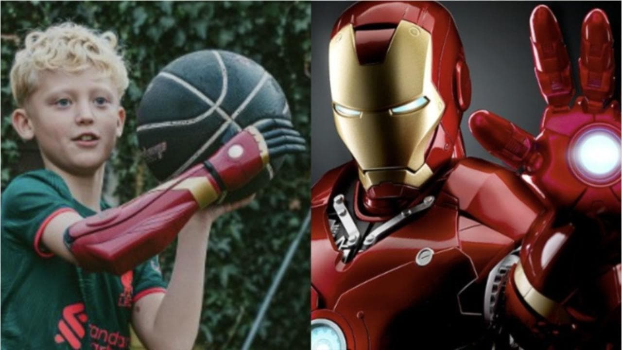 Il piccolo Harry, nato senza un avambraccio, riceve un braccio bionico come quello di Iron Man