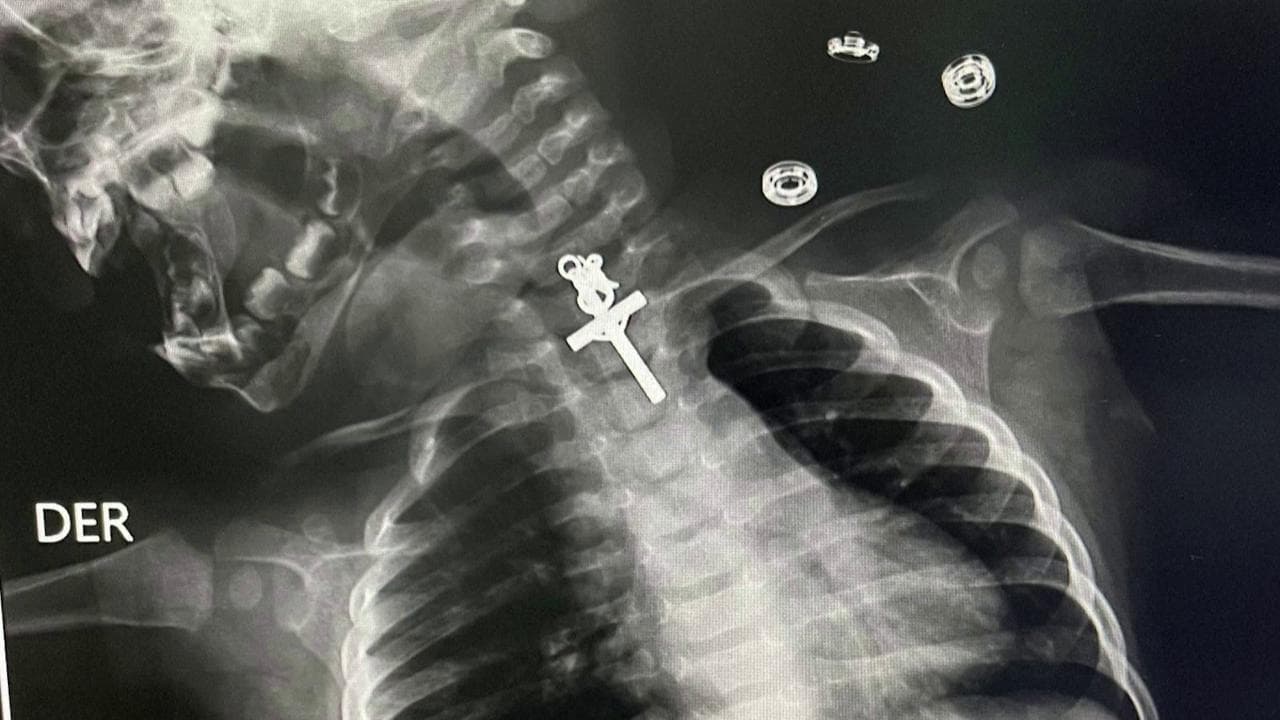 Perù, bambina di 10 mesi ingoia un crocifisso: l'insolita radiografia che mostra l'incidente