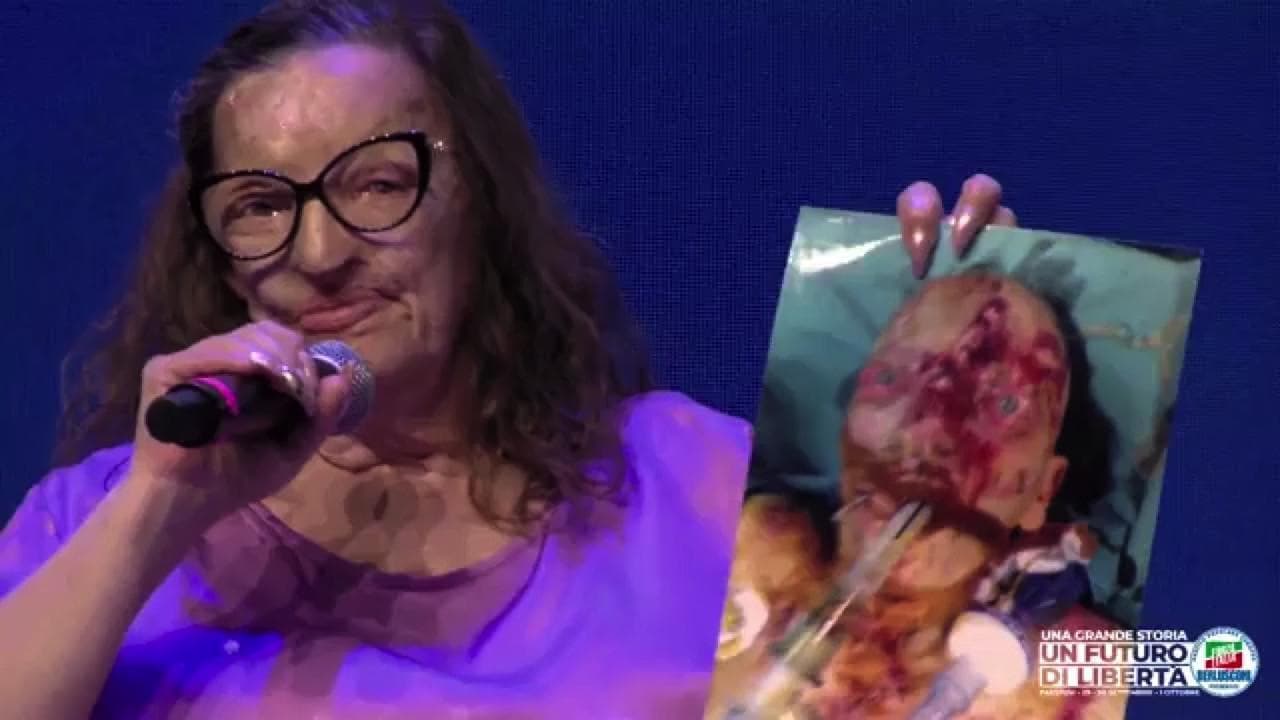 Filomena Lamberti, sfregiata dal marito con l'acido: la donna mostra la foto choc
