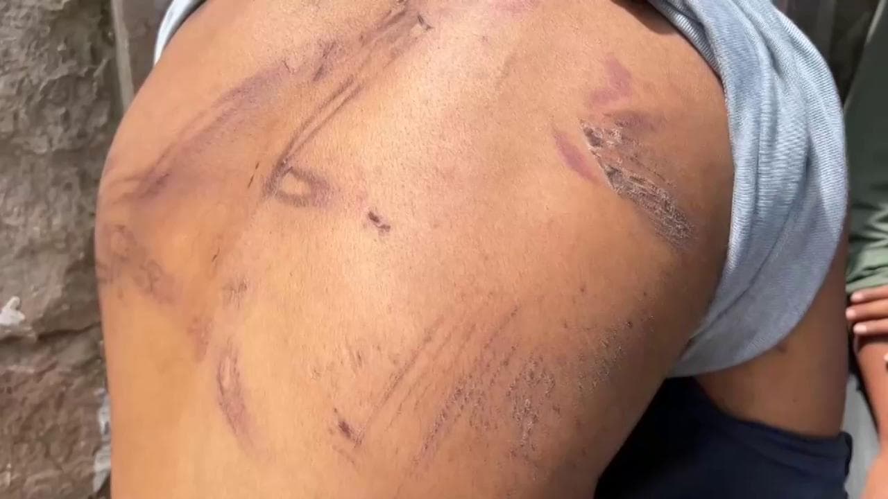 Melilla, giovane migrante mostra le ferite riportate nel viaggio verso l'Europa: il suo corpo è una 'mappa' della violenza