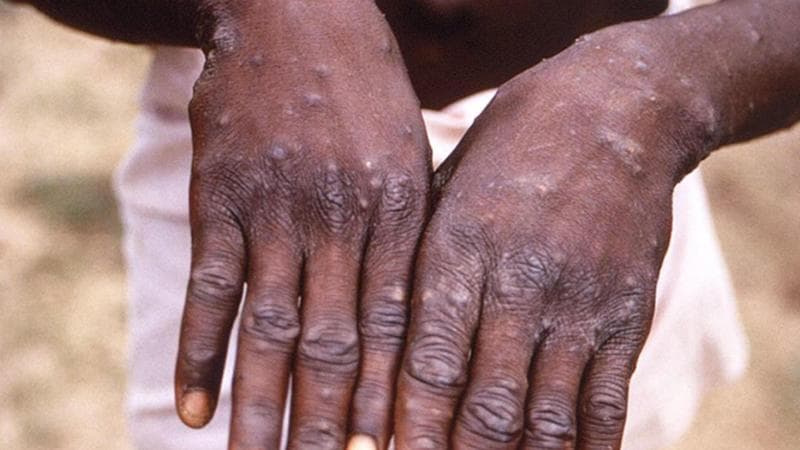 L’Oms dichiara il vaiolo delle scimmie un’emergenza sanitaria mondiale
