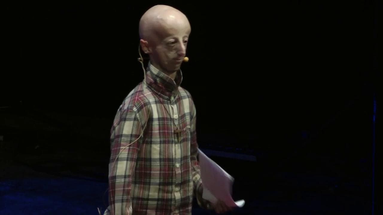 Sammy Basso sulla sua malattia: "A volte gli ostacoli sono opportunità"